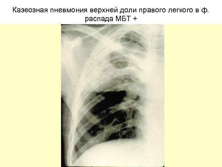 Казеозная пневмония верхней доли правого легкого в ф. распада МБТ + 