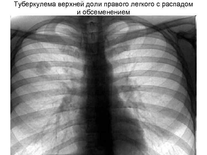 Туберкулема верхней доли правого легкого с распадом и обсеменением 