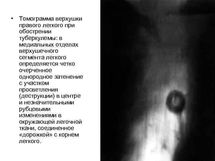  • Томограмма верхушки правого легкого при обострении туберкулемы: в медиальных отделах верхушечного сегмента