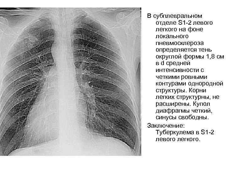 В субплевральном отделе S 1 -2 левого легкого на фоне локального пневмосклероза определяется тень