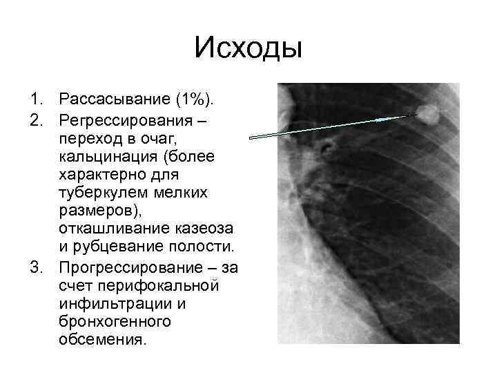 Исходы 1. Рассасывание (1%). 2. Регрессирования – переход в очаг, кальцинация (более характерно для