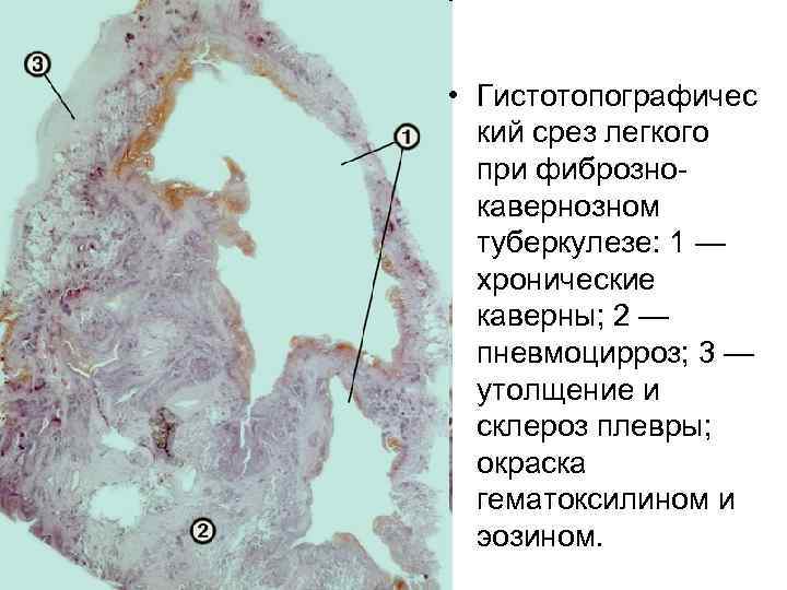  • Гистотопографичес кий срез легкого при фибрознокавернозном туберкулезе: 1 — хронические каверны; 2