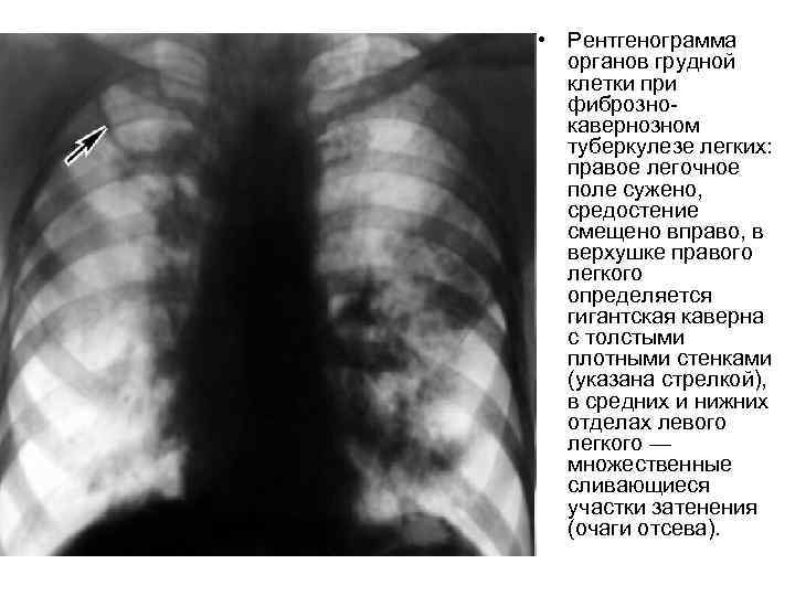  • Рентгенограмма органов грудной клетки при фибрознокавернозном туберкулезе легких: правое легочное поле сужено,