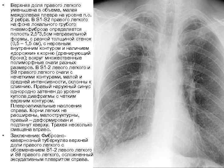  • • Верхняя доля правого легкого уменьшена в объеме, малая междолевая плевра на