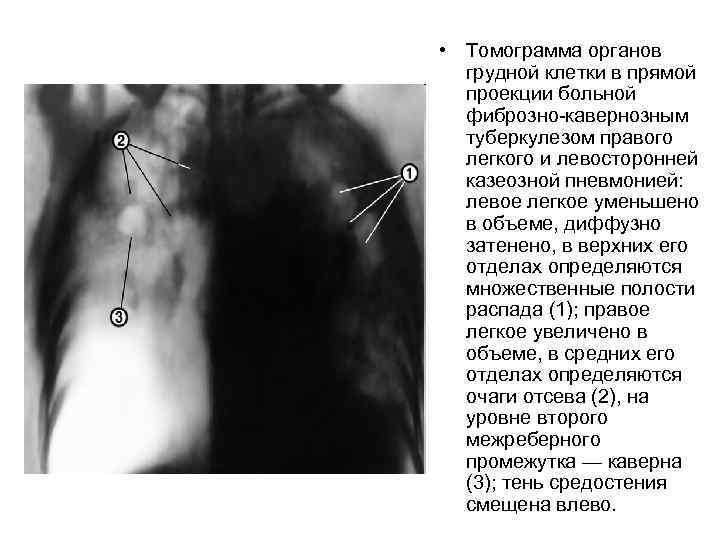  • Томограмма органов грудной клетки в прямой проекции больной фиброзно-кавернозным туберкулезом правого легкого