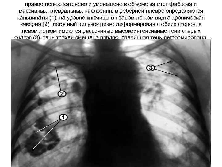 правое легкое затенено и уменьшено в объеме за счет фиброза и массивных плевральных наслоений,