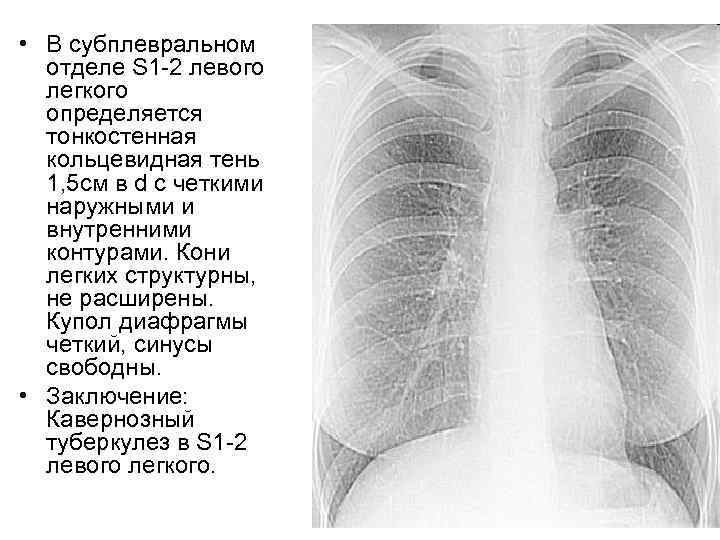  • В субплевральном отделе S 1 -2 левого легкого определяется тонкостенная кольцевидная тень