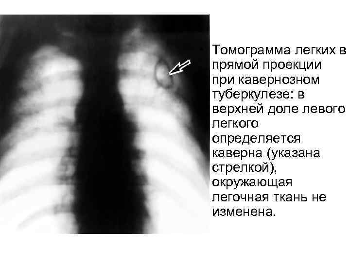  • Томограмма легких в прямой проекции при кавернозном туберкулезе: в верхней доле левого