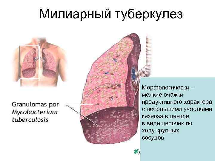 Милиарный туберкулез Морфологически – мелкие очажки продуктивного характера с небольшими участками казеоза в центре,