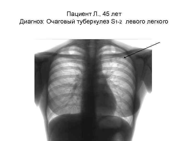 Пациент Л. , 45 лет Диагноз: Очаговый туберкулез S 1 -2 левого легкого 