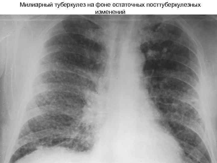 Милиарный туберкулез на фоне остаточных посттуберкулезных изменений 