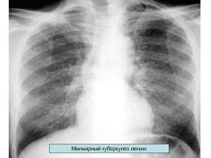 Милиарный туберкулез легких 