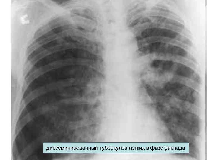 диссеминированный туберкулез легких в фазе распада 