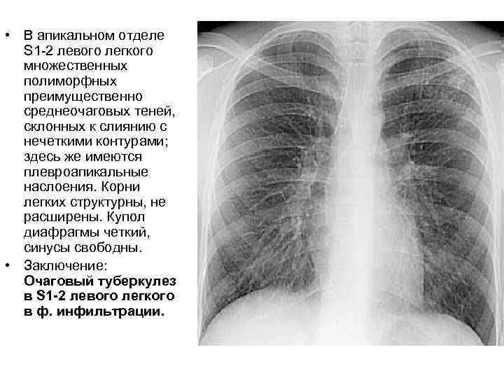  • В апикальном отделе S 1 -2 левого легкого множественных полиморфных преимущественно среднеочаговых