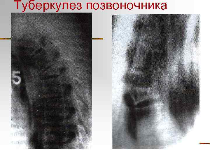 Туберкулез позвоночника 