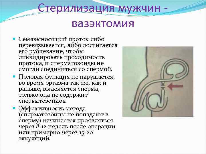 Что такое вазэктомия. Контрацепция вазэктомия. Вазэктомия стерилизация. Мужская стерилизация вазэктомия.