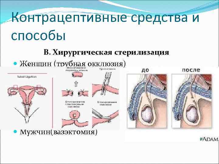 Женская стерилизация презентация