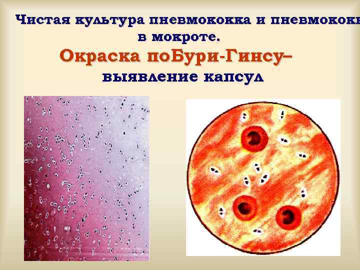 Метод бурри гинса. Капсула бактерий окраска по Бурри-ГИНСУ. Пневмококк по Бурри ГИНСУ. Окраска капсул по методу Бурри-Гинса.