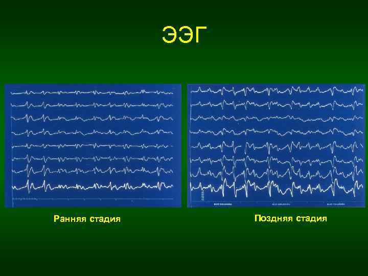 ЭЭГ Ранняя стадия Поздняя стадия 