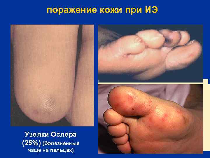 поражение кожи при ИЭ Узелки Ослера (25%) (болезненные чаще на пальцах) 