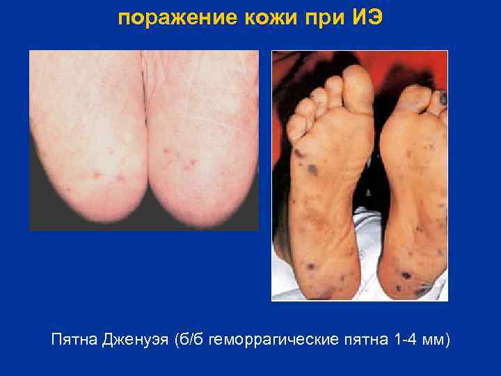 поражение кожи при ИЭ Пятна Дженуэя (б/б геморрагические пятна 1 -4 мм) 