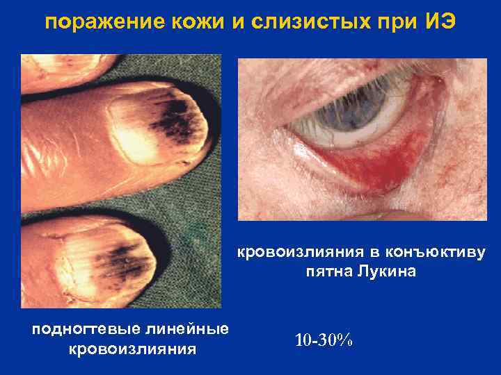 поражение кожи и слизистых при ИЭ кровоизлияния в конъюктиву пятна Лукина подногтевые линейные кровоизлияния