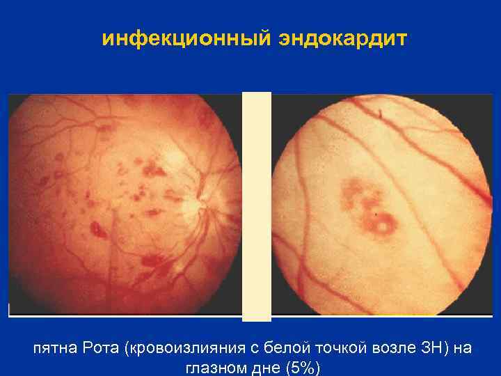 инфекционный эндокардит пятна Рота (кровоизлияния с белой точкой возле ЗН) на глазном дне (5%)
