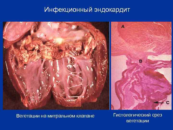 Инфекционный эндокардит Вегетации на митральном клапане Гистологический срез вегетации 