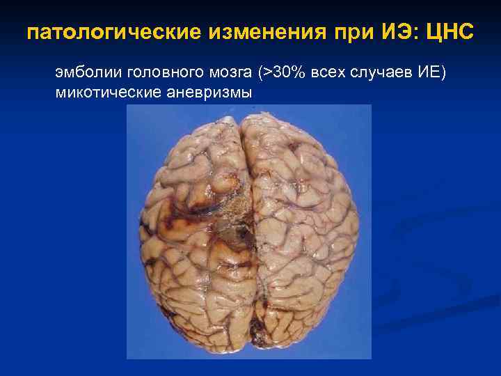 патологические изменения при ИЭ: ЦНС эмболии головного мозга (>30% всех случаев ИЕ) микотические аневризмы