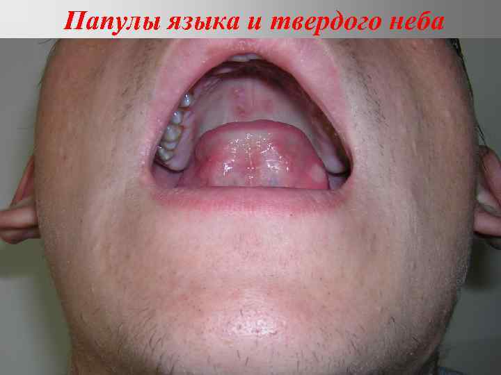Папулы языка и твердого неба 