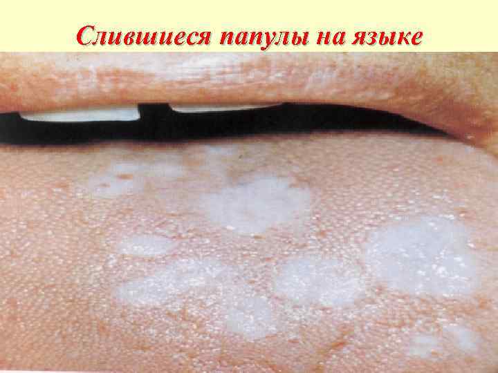 Слившиеся папулы на языке 