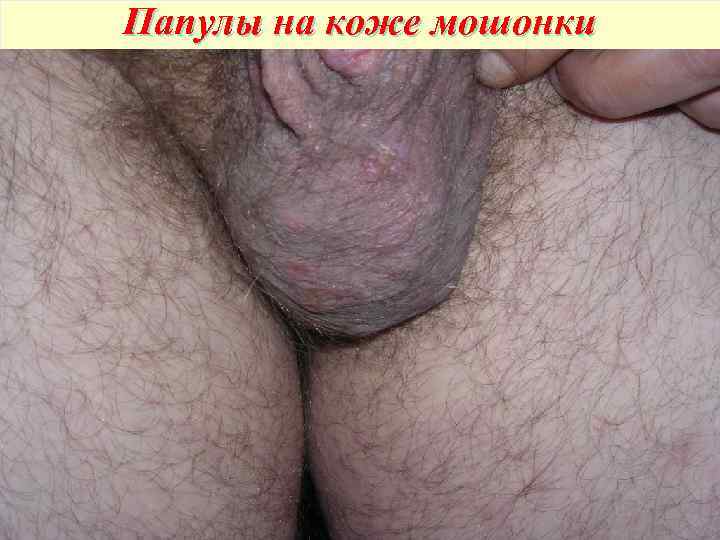 Папулы на коже мошонки 