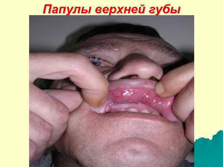 Папулы верхней губы 
