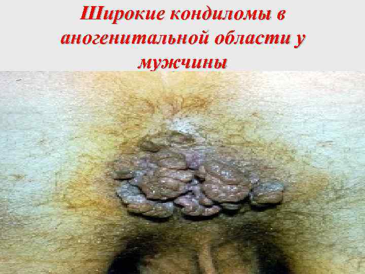 Широкие кондиломы в аногенитальной области у мужчины 