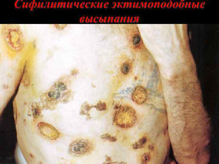 Сифилитические эктимоподобные высыпания 