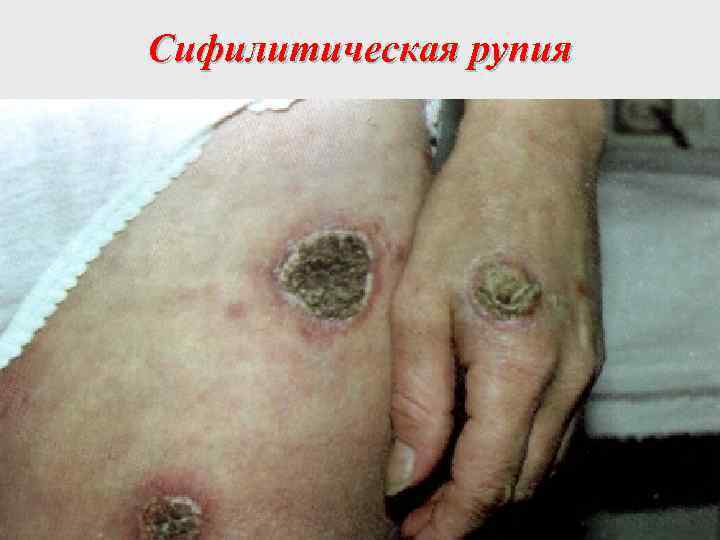 Сифилитическая рупия 