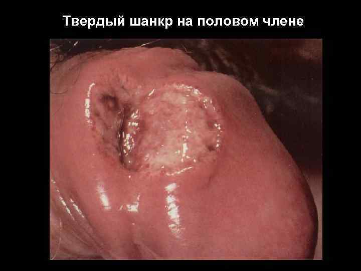 Твердый шанкр на половом члене 