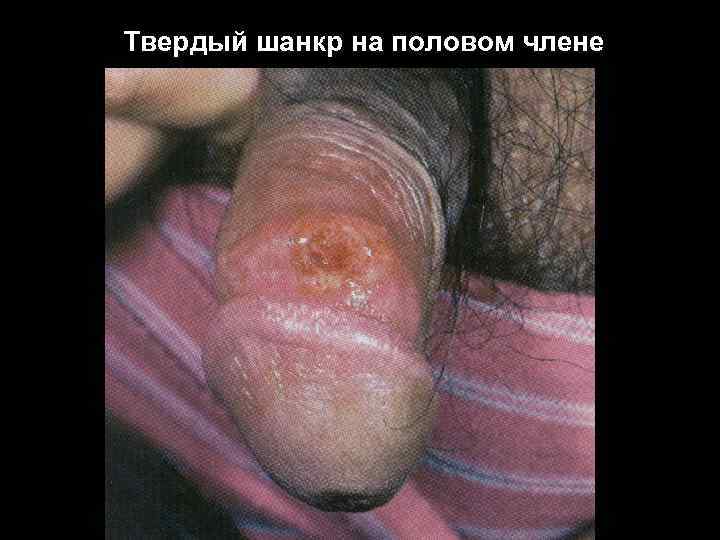 Твердый шанкр на половом члене 