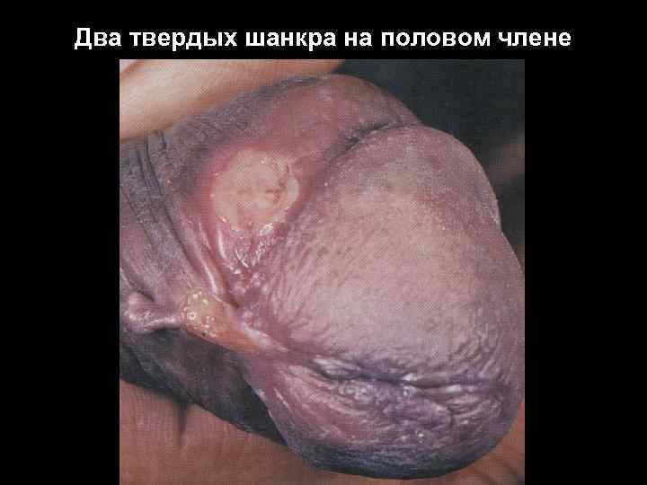 Два твердых шанкра на половом члене 