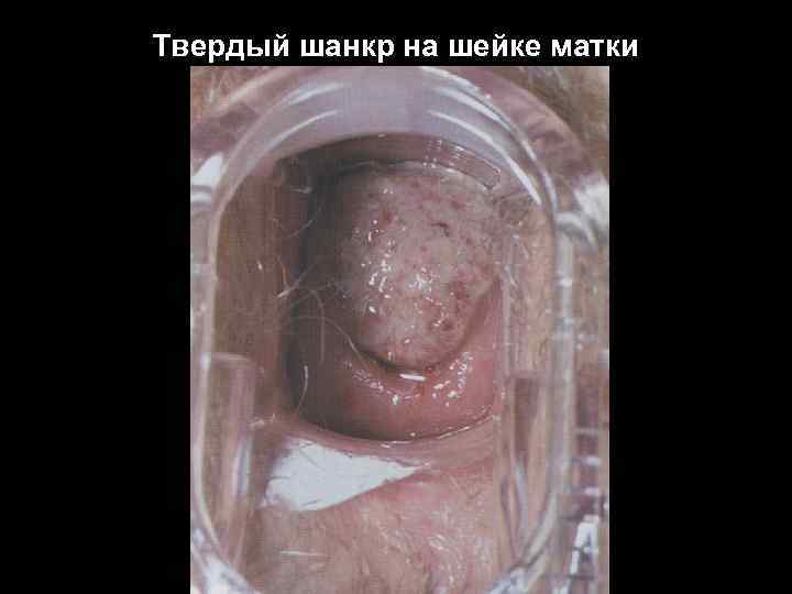 Твердый шанкр на шейке матки 