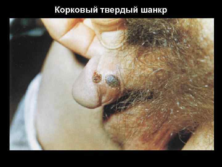 Корковый твердый шанкр 