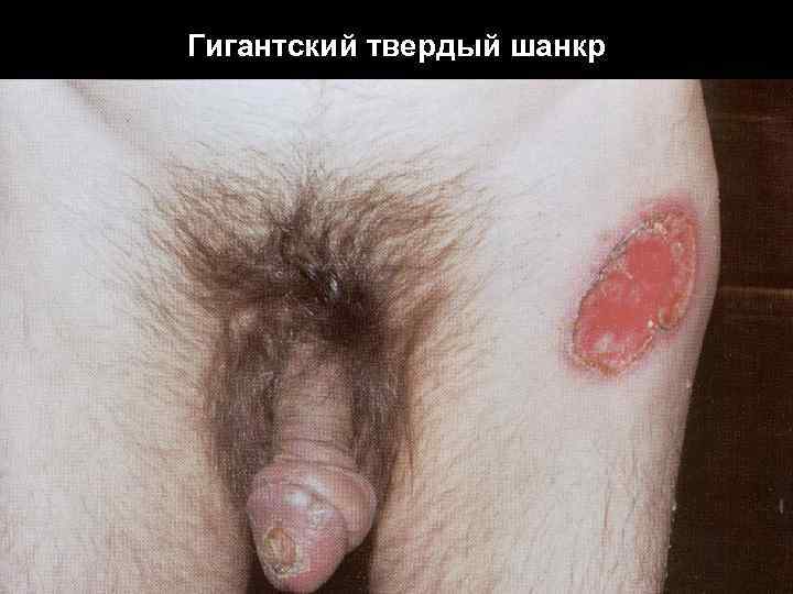 Гигантский твердый шанкр 