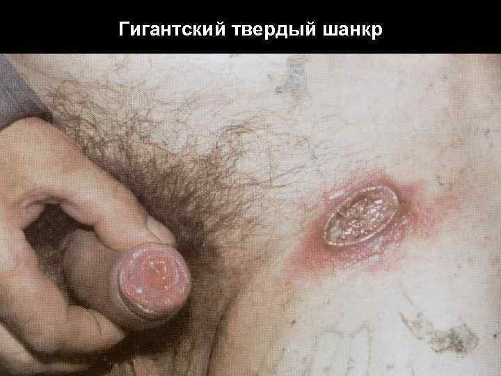 Гигантский твердый шанкр 