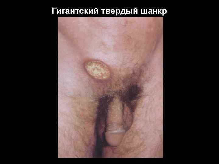 Гигантский твердый шанкр 