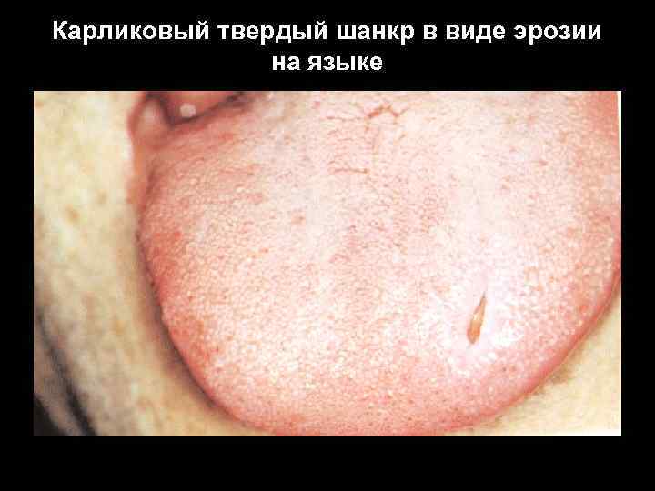 Карликовый твердый шанкр в виде эрозии на языке 