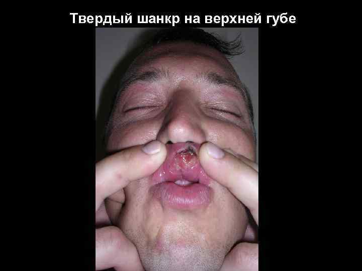 Твердый шанкр на верхней губе 