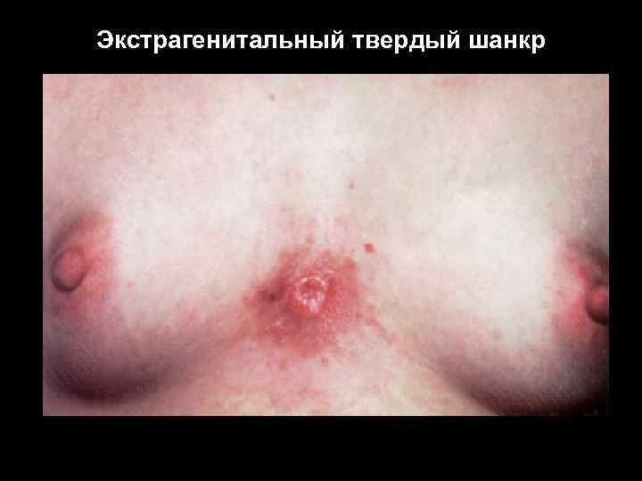 Экстрагенитальный твердый шанкр 
