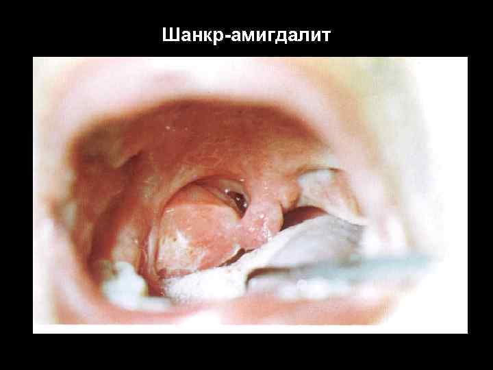 Шанкр-амигдалит 