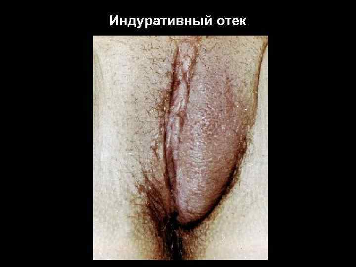 Индуративный отек 