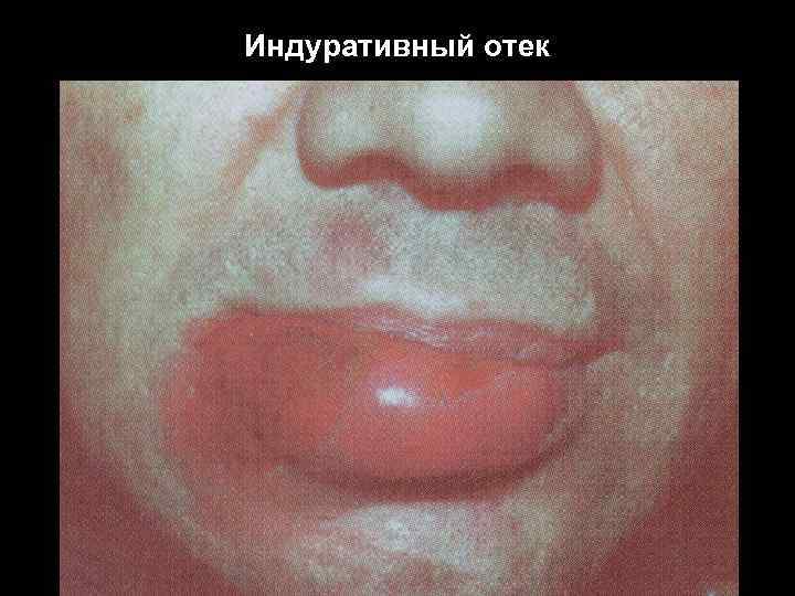 Индуративный отек 